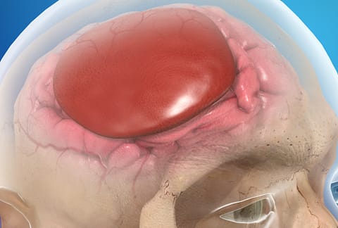 picture of subdural haematoma on human brain